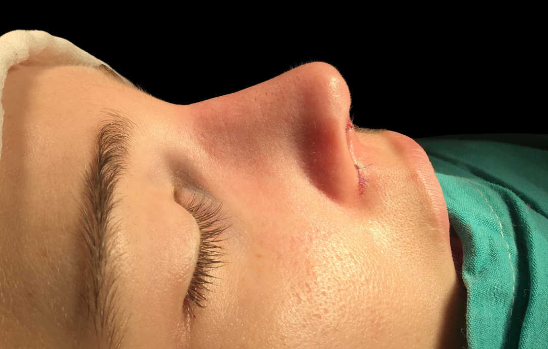 antalya burun estetiği