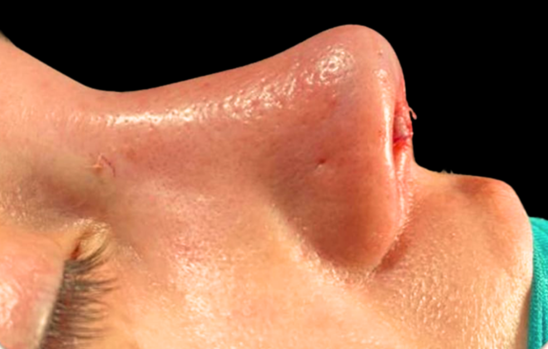 piezo burun estetiği antalya, antalya burun estetiği tavsiye , piezo burun estetiği fiyatları antalya