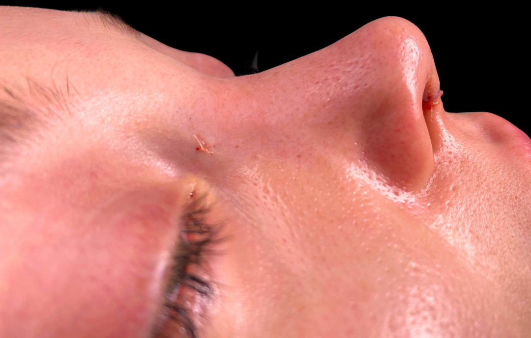 Burun Eğriliği Ameliyatı